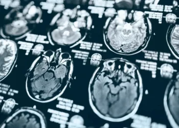 Alzheimer: o que há de mais novo na medicina para combater a doença?
