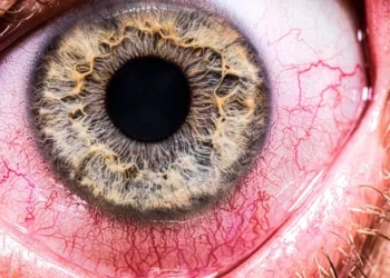 Entenda como o metanol destrói o nervo óptico e pode causar cegueira