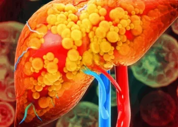 Gordura no fígado: dicas simples para evitar a esteatose hepática