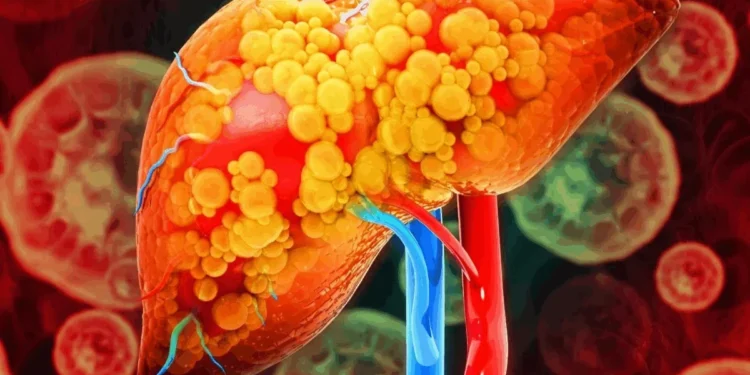 Gordura no fígado: dicas simples para evitar a esteatose hepática