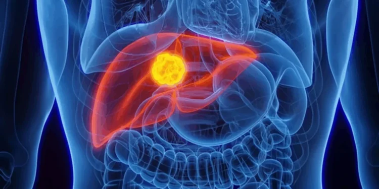 Câncer de fígado: conheça as principais causas e como se prevenir