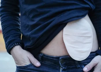 A cirurgia de ostomia é um procedimento que pode salvar vidas e é realizado em diversas condições de saúde