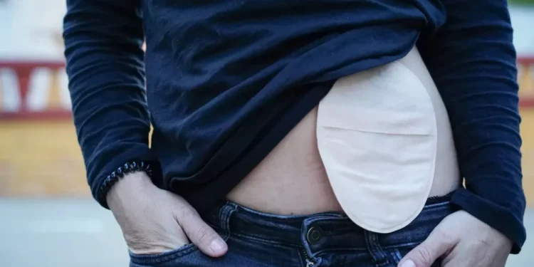 A cirurgia de ostomia é um procedimento que pode salvar vidas e é realizado em diversas condições de saúde