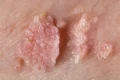 Verrugas na pele e mucosas com aspecto de couve-flor é sintoma do HPV - Divulgação Internet
